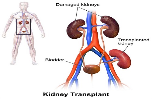 kidney transplant in India