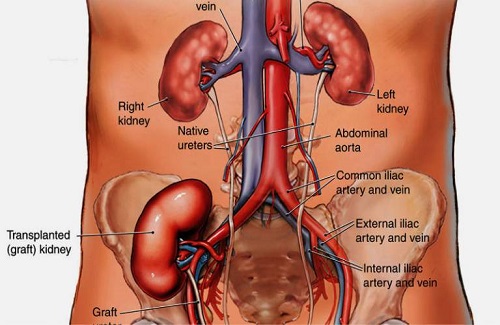 kidney transplant in Turkey