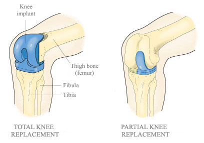 Knee Replacement Procedure