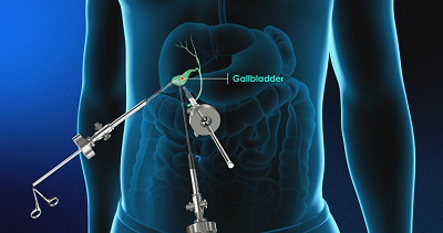 Laparoscopic Gallbladder Surgery 