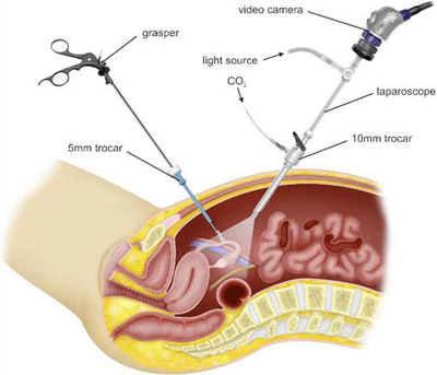 Laporoscopic Hysterectomy