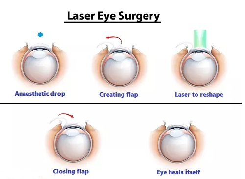 Laser Eye Surgery in Turkey - Vaidam Health