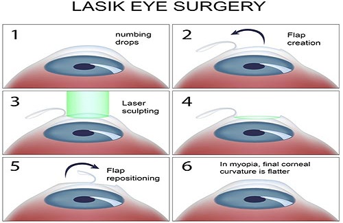 Lasik eye surgery procedure