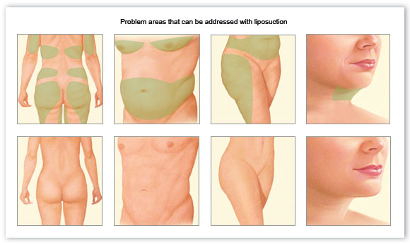 What are ways to reduce swelling after liposuction? - Quora