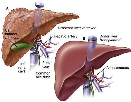 liver transplant in Turkey - Vaidam