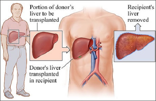 trasplante de hígado