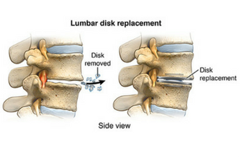 tratamentul coloanei vertebrale cervicale și lombare