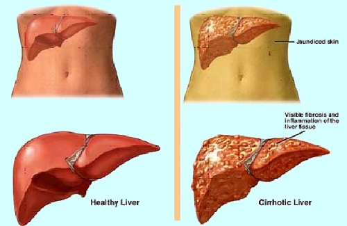 diseased liver 