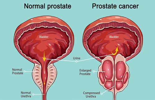 prostatitis zene
