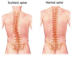 Scoliotic Spine