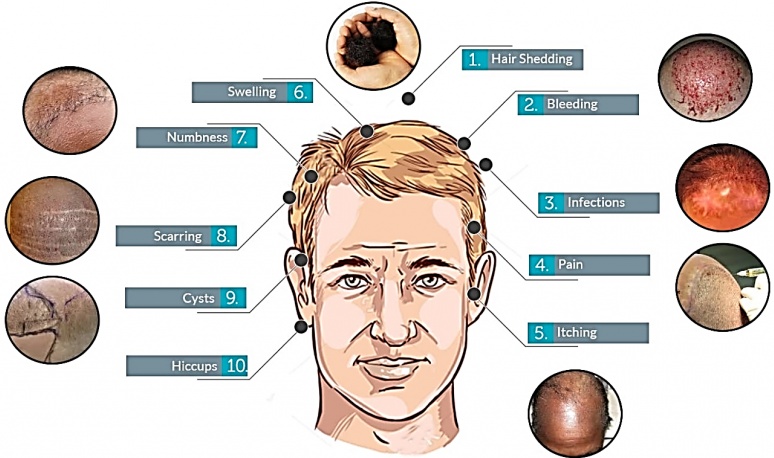 Side Effects Of Hair Transplant