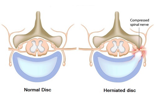 Spinal Herniated disc