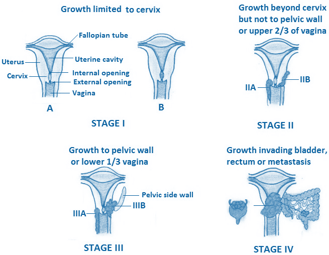 Stades du cancer du col de l'utérus