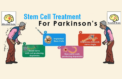 stem cells for Parkinson's disease