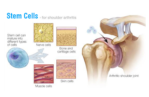 use of stem cells for arthritis