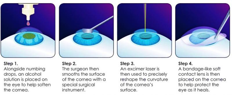 Steps in PHOTOREFRACTIVE KERATECTOMY