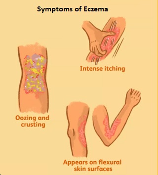 Symptoms of Eczema