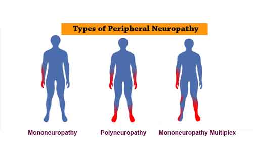 types of peripheral neuropathy