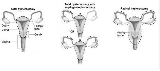 Types Of Hysterectomy
