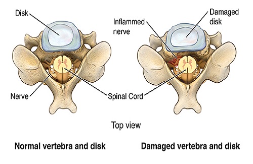 types of spine surgery