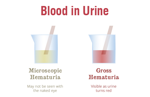 Pourquoi avez-vous du sang dans les urines ? | Vaidam Santé