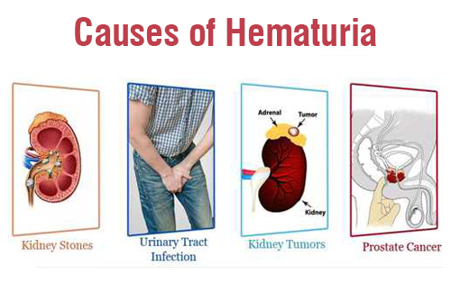 causes of hematuria