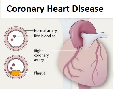 What is Coronary Heart Disease