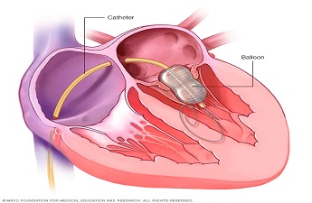 All About Valvuloplasty and  Interventional Cardiologist Dr. Fayaz Shawl’s Proficiency in this