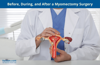 मायोमेक्टोमी सर्जरी से पहले, दौरान और बाद में क्या अपेक्षा करें?