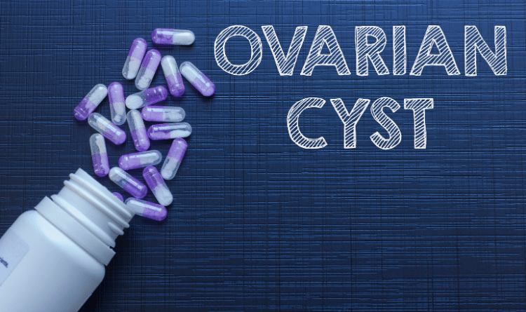 ovarian cyst intro image