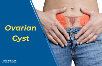 Understanding Ovarian Cysts: Types, Causes, and Symptoms