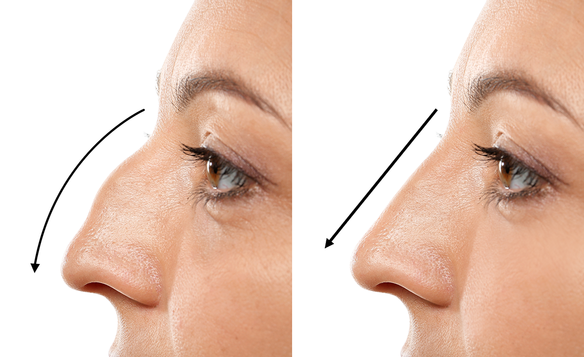Answers to all your Queries About Rhinoplasty and Its Treatment By Plastic Surgeon Dr. Mohan Rangaswamy are Here