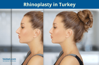 Rhinoplasty in Turkey 