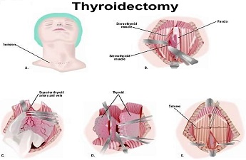 Endocrinologist Dr. Alshimaa Rezk’s Expertise lies in Thyroidectomy