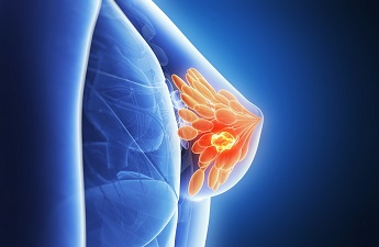 डॉ ताप्ती सेन: स्तन कैंसर का इलाज प्रदान करने वाले अग्रणी सर्जिकल ऑन्कोलॉजिस्ट