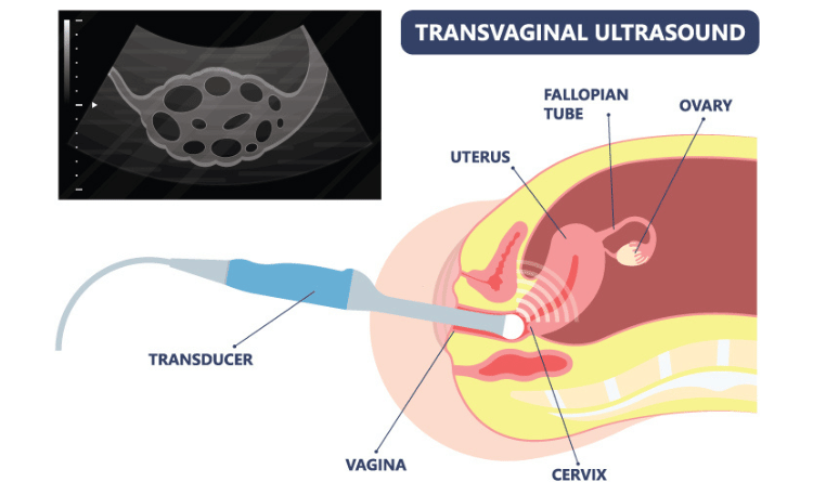 transvaginal