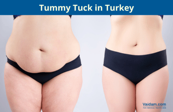 Turkiyadagi Tummy Tuck