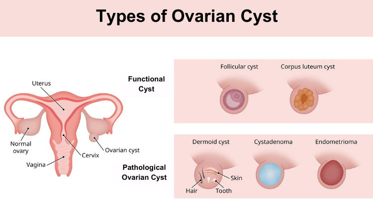 types of ovarian cyst