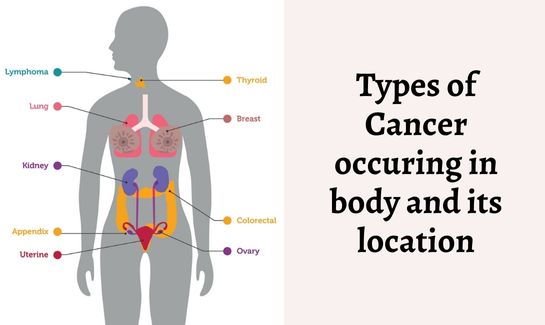 types of cancer and its location