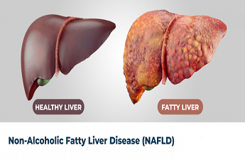 Being Overweight Can Lead To Non-Alcoholic Fatty Liver Disease. Know About Its Cure By Gastroenterologist Dr. Hoe Chee Hoong