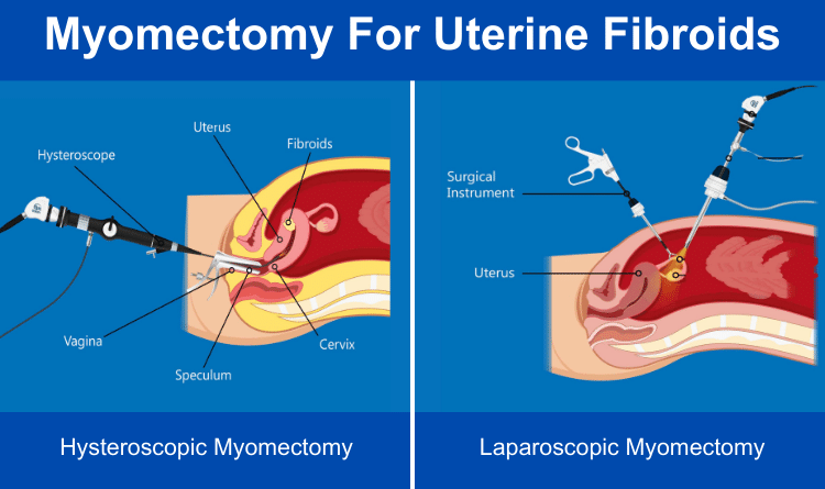 uterine fibroid treatment