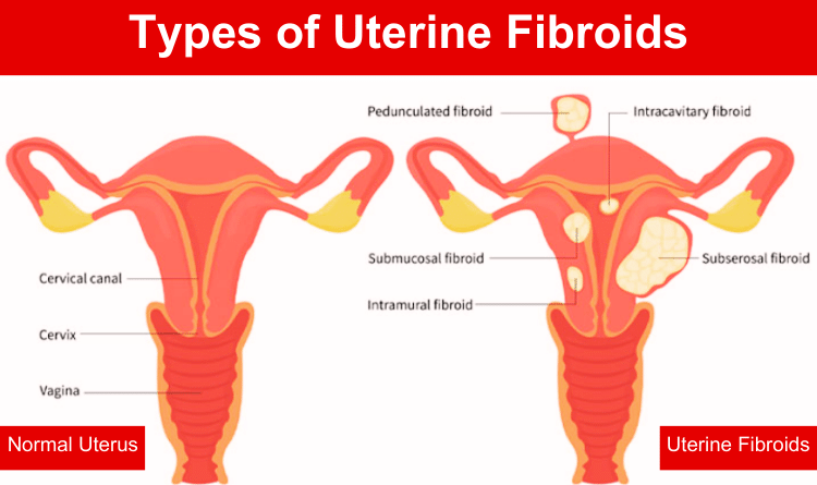 uterine fibroids types
