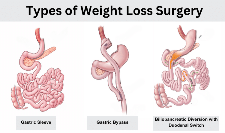 weight loss surgery types
