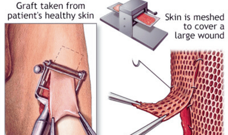 skin graft procedure