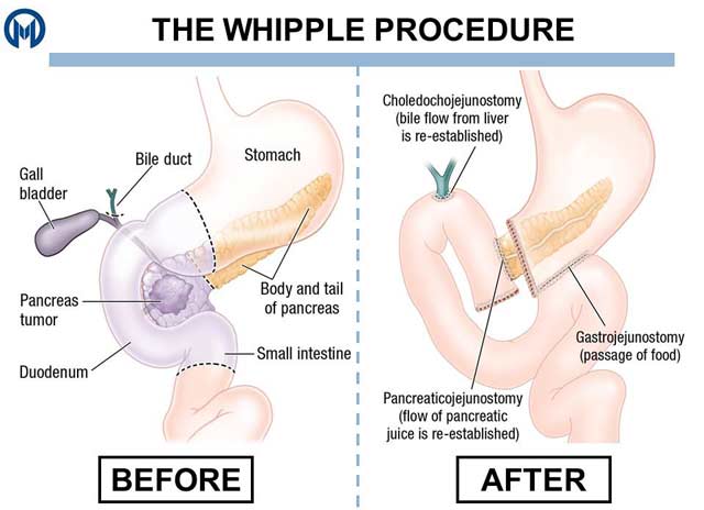 Are You aware of Whipple’s Procedure and its Treatment by General Surgeon Dr. Alya Al Mazrouei?