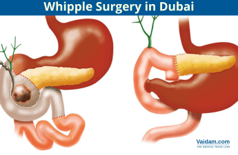 Whipple Surgery in Dubai