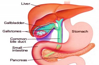 Gall Stones – Symptoms, Prevention and Gall Bladder Removal by Dr. Prasanna Kumar Reddy, Surgical Gastroenterologist, MBBS, FRCS